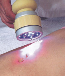 Laseroterapija u cilju lipolize