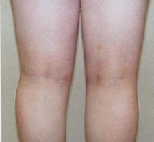Pre i posle intervencije - kolena izgled otpozadi