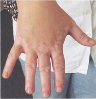 Vitiligo oboljenje Vitiligo oboljenje