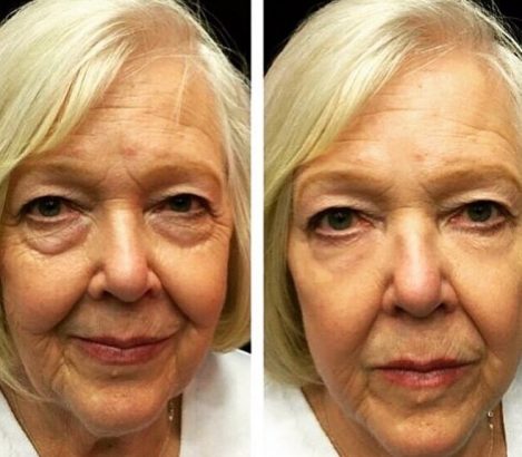 Instantly ageless mikrokrema - pre i posle