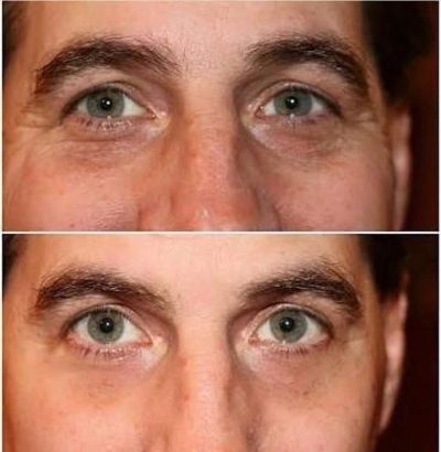 Instantly ageless mikrokrema - pre i posle