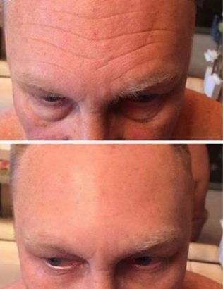 Instantly ageless mikrokrema - pre i posle