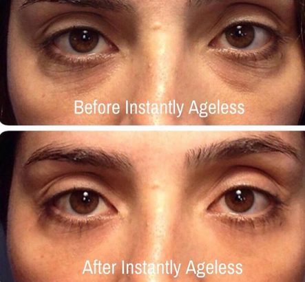 Instantly ageless mikrokrema - pre i posle