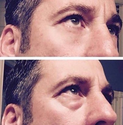Instantly ageless mikrokrema - pre i posle