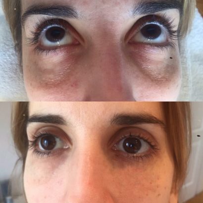 Instantly ageless mikrokrema - pre i posle