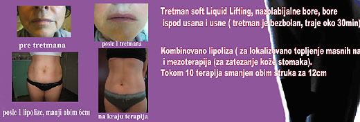 Lipoliza Lipoliza