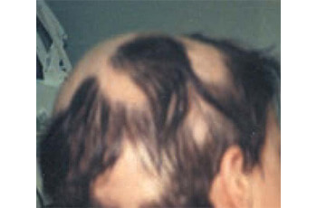 Alopecia areata - pre tretmana